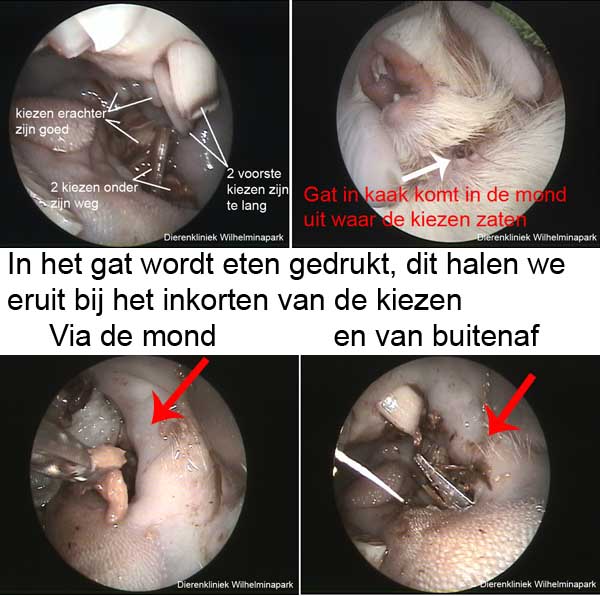 Door de tandwortelontsteking raakten de twee voorste kiezen verloren.