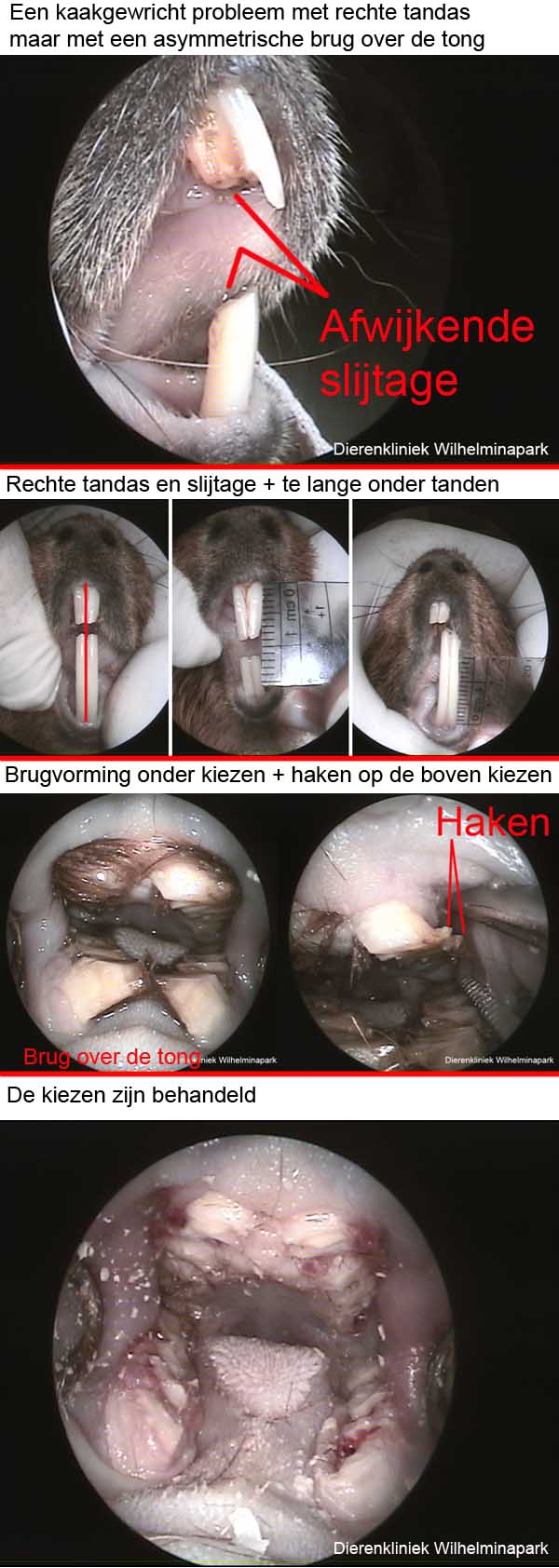 Een brug over de tong en haken op de bovenkaak kiezen