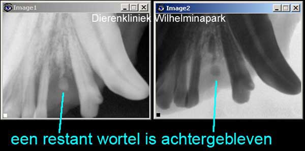 Een rontgenfoto laat zien dat het abces ontstaan is door een wortlepuntrest.