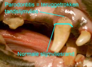 Ernstig teruggetrokken tandslijmvlies door tandsteen.