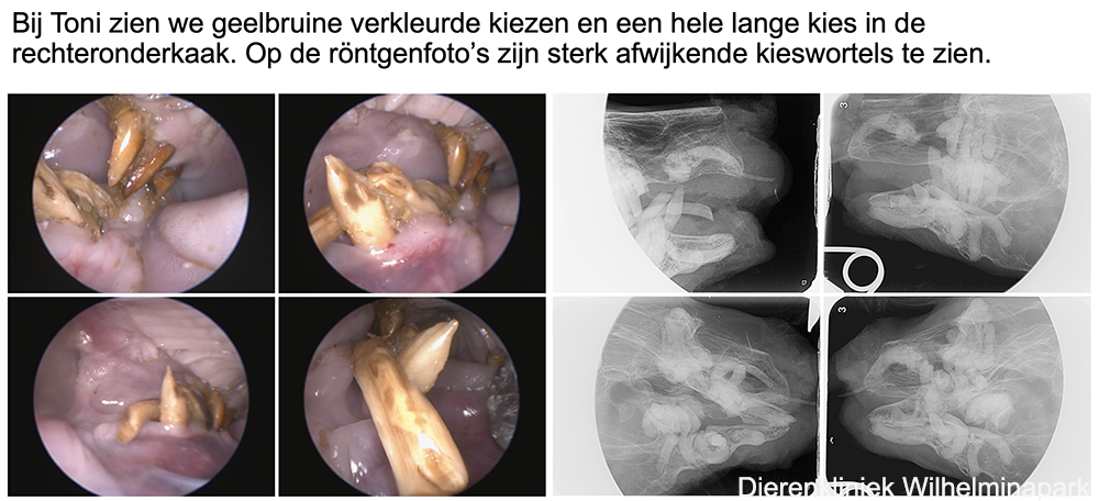 Afwijkende kiezen door ADD of tandresorptie